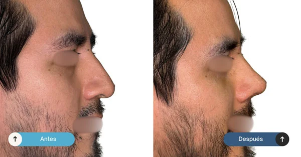 rinoplastia-antes-despues-2
