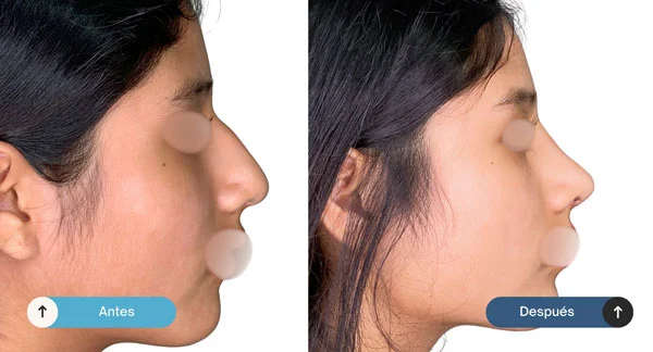 rinoplastia-antes-despues-3