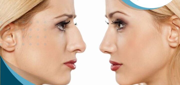 rinoplastia-para-reducir-tamano-nariz