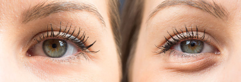 blefaroplastia-rejuvenecimiento-ojos
