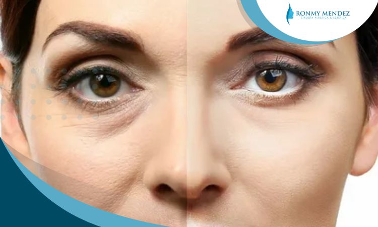 la-blefaroplastia-en-lima-peru