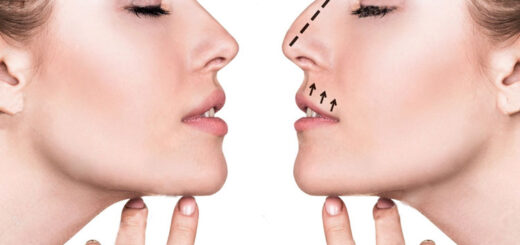 rinoplastia-personalizada
