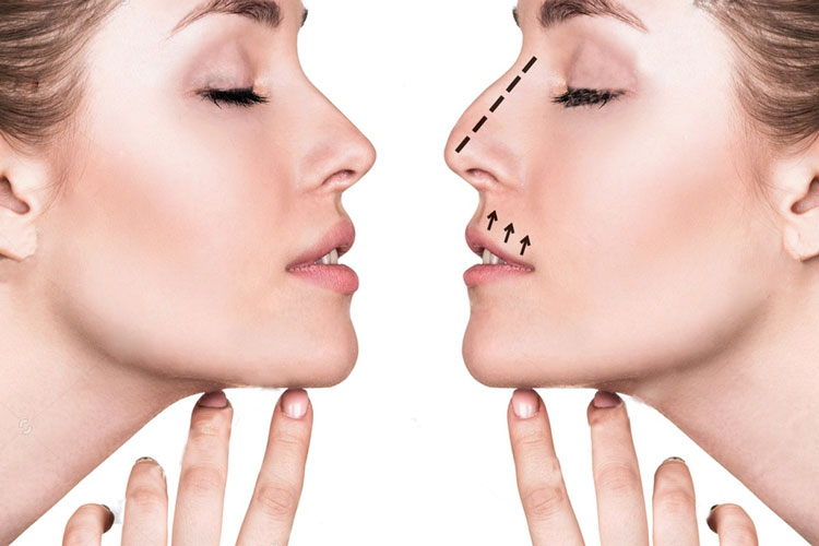 rinoplastia-personalizada