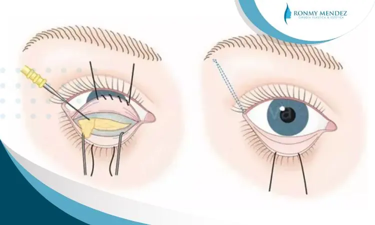 tipos-de-blefaroplastia