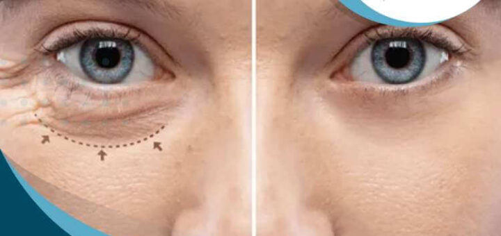 blefaroplastia-inferior-beneficios-resultados