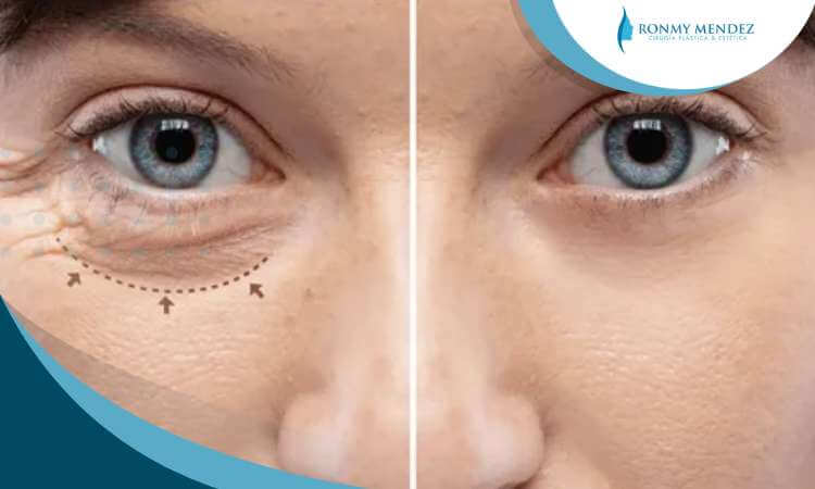blefaroplastia-inferior-beneficios-resultados