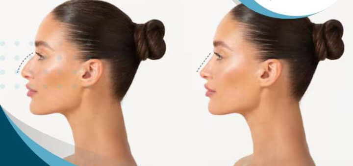 rinoplastia-funcional