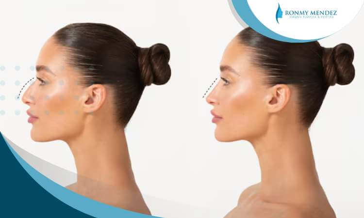 rinoplastia-funcional