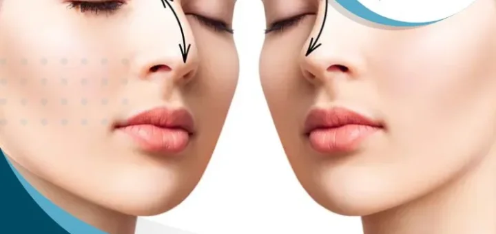 edad-minima-rinoplastia