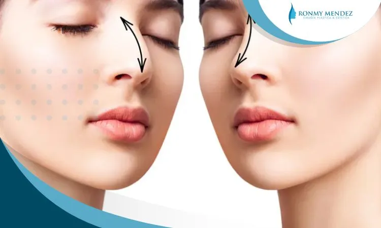 edad-minima-rinoplastia