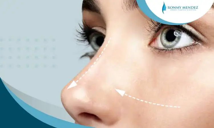 tipo-rinoplastia-para-mujeres