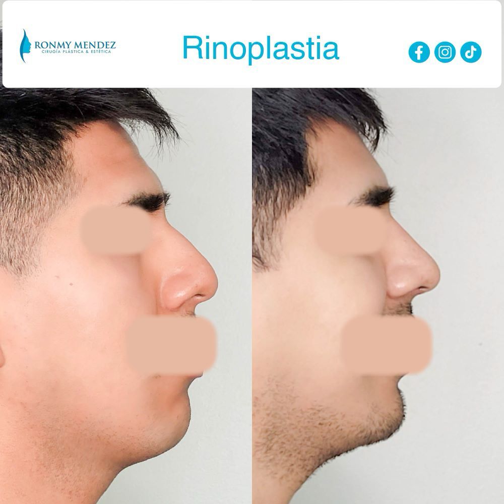 rinoplastia-antes-despues-6