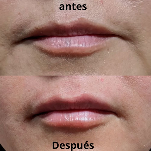 acido-hialuronico-2