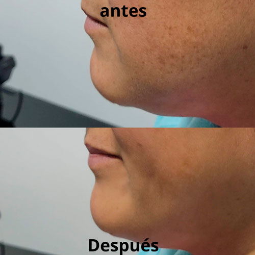 acido-hialuronico-3