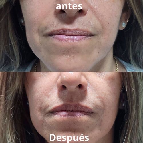 acido-hialuronico-4