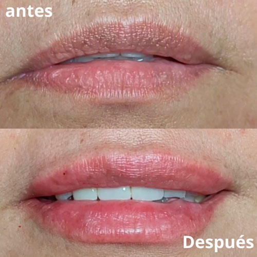 acido-hialuronico-6