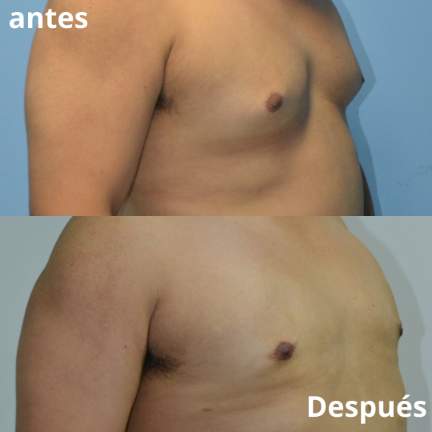 ginecomastia-antes-despues-1