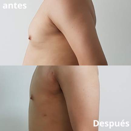 ginecomastia-antes-despues-10