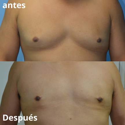ginecomastia-antes-despues-2