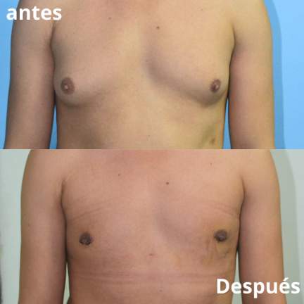 ginecomastia-antes-despues-4