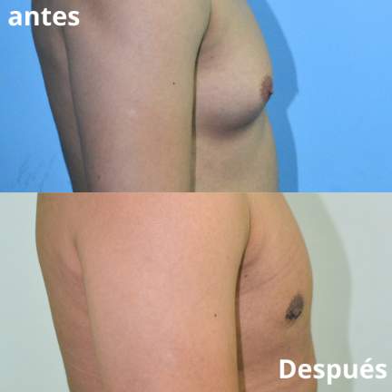 ginecomastia-antes-despues-5