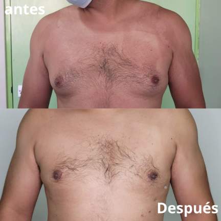 ginecomastia-antes-despues-6
