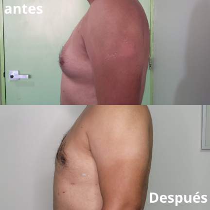 ginecomastia-antes-despues-7