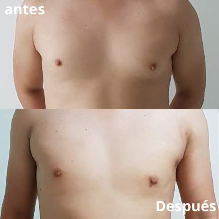 ginecomastia-antes-despues-8