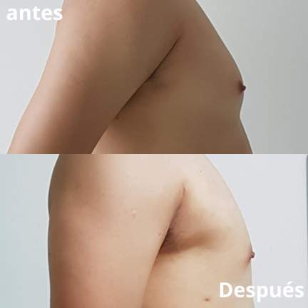 ginecomastia-antes-despues-9