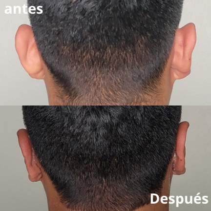 otoplastia-cirugia-orejas-1