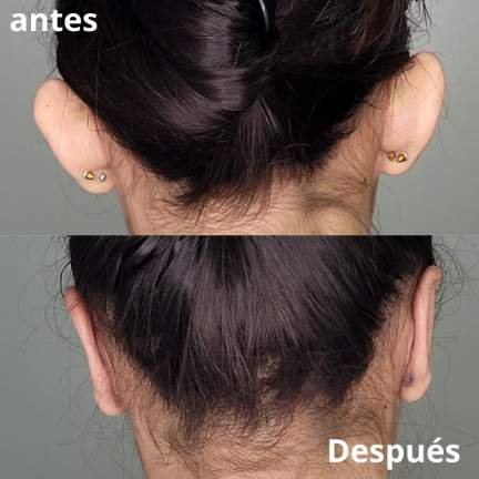 otoplastia-cirugia-orejas-2