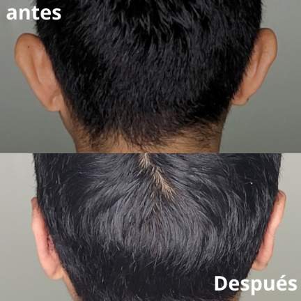 otoplastia-cirugia-orejas-3