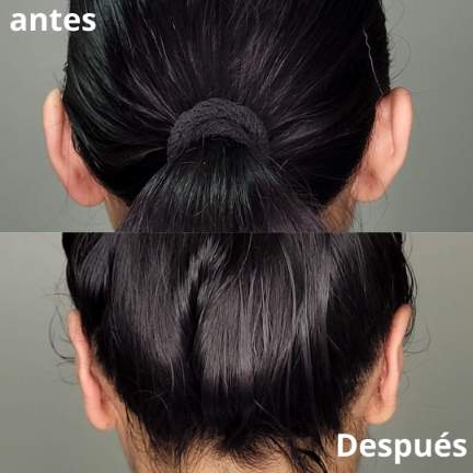 otoplastia-cirugia-orejas-4