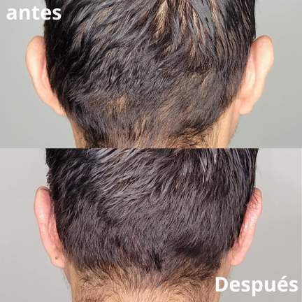 otoplastia-cirugia-orejas-5